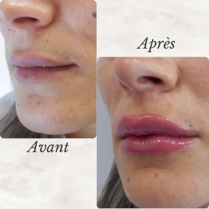 Chirurgie du visage 40 Dr Berrada Khalid - Chirurgien esthétique et plastique à Fès FILLER dr berrada khalid photo avant apres 4 Chirurgie du visage