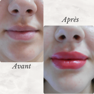 Chirurgie du visage 42 Dr Berrada Khalid - Chirurgien esthétique et plastique à Fès FILLER dr berrada khalid photo avant apres 7 Chirurgie du visage