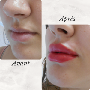 Chirurgie du visage 43 Dr Berrada Khalid - Chirurgien esthétique et plastique à Fès FILLER dr berrada khalid photo avant apres 8 Chirurgie du visage