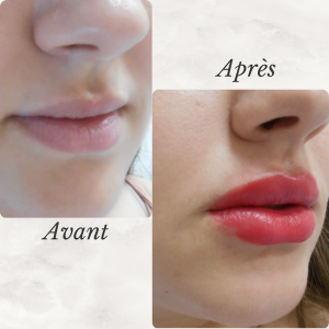 Chirurgie du visage 44 Dr Berrada Khalid - Chirurgien esthétique et plastique à Fès FILLER dr berrada khalid photo avant apres 9 Chirurgie du visage