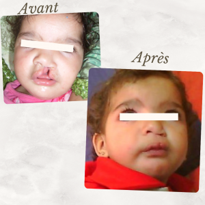 Dr Berrada Khalid - Chirurgien esthétique et plastique à Fès Fente labiale dr berrada khalid photo avant apres 11 Chirurgie réparatrice