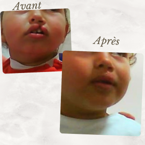 Dr Berrada Khalid - Chirurgien esthétique et plastique à Fès Fente labiale dr berrada khalid photo avant apres 3 Chirurgie réparatrice