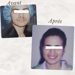 Dr Berrada Khalid - Chirurgien esthétique et plastique à Fès Fente labiale dr berrada khalid photo avant apres 7 Chirurgie réparatrice