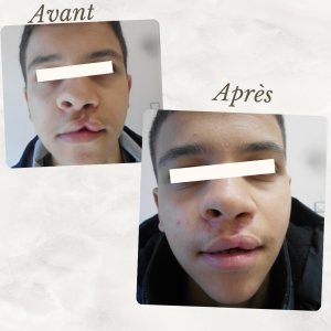 Accueil 23 Dr Berrada Khalid - Chirurgien esthétique et plastique à Fès Fente labiale dr berrada khalid photo avant apres 9 Accueil