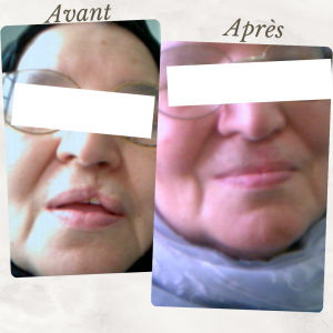 Dr Berrada Khalid - Chirurgien esthétique et plastique à Fès Fente labiale dr berrada khalid photo avant apresok 3 Chirurgie réparatrice