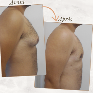Dr Berrada Khalid - Chirurgien esthétique et plastique à Fès GYNECOMASTIE dr berrada khalid photo avant apres16 chirurgie de la Silhouette