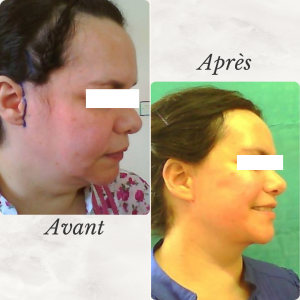 Chirurgie du visage 1 Dr Berrada Khalid - Chirurgien esthétique et plastique à Fès LIFTING de visage dr berrada khalid photo avant apres2 Chirurgie du visage