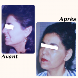 Chirurgie du visage 2 Dr Berrada Khalid - Chirurgien esthétique et plastique à Fès LIFTING de visage dr berrada khalid photo avant apres4 Chirurgie du visage