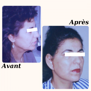 Chirurgie du visage 3 Dr Berrada Khalid - Chirurgien esthétique et plastique à Fès LIFTING de visage dr berrada khalid photo avant apres5 Chirurgie du visage