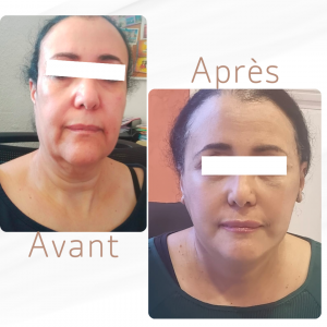 Dr Berrada Khalid - Chirurgien esthétique et plastique à Fès LIFTING de visage dr berrada khalid photo avant apres7 1 Interventions