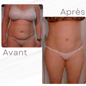Dr Berrada Khalid - Chirurgien esthétique et plastique à Fès LIPOSUCCION dr berrada khalid photo avant apres1 1 chirurgie de la Silhouette