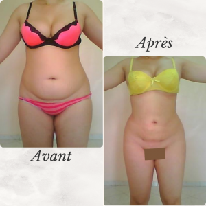 Dr Berrada Khalid - Chirurgien esthétique et plastique à Fès LIPOSUCCION dr berrada khalid photo avant apres1 chirurgie de la Silhouette