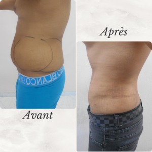 Dr Berrada Khalid - Chirurgien esthétique et plastique à Fès LIPOSUCCION dr berrada khalid photo avant apres10 chirurgie de la Silhouette