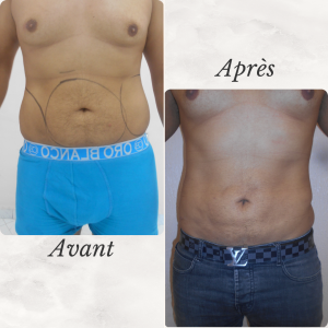 Dr Berrada Khalid - Chirurgien esthétique et plastique à Fès LIPOSUCCION dr berrada khalid photo avant apres11 chirurgie de la Silhouette