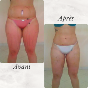 Dr Berrada Khalid - Chirurgien esthétique et plastique à Fès LIPOSUCCION dr berrada khalid photo avant apres15 chirurgie de la Silhouette
