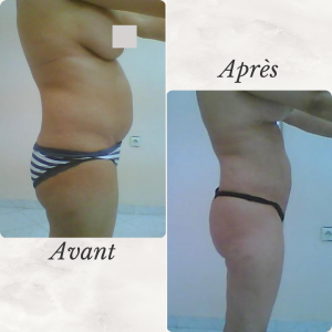 Dr Berrada Khalid - Chirurgien esthétique et plastique à Fès LIPOSUCCION dr berrada khalid photo avant apres17 chirurgie de la Silhouette