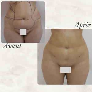 Dr Berrada Khalid - Chirurgien esthétique et plastique à Fès LIPOSUCCION dr berrada khalid photo avant apres19 chirurgie de la Silhouette