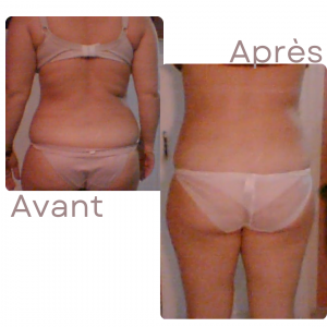 Dr Berrada Khalid - Chirurgien esthétique et plastique à Fès LIPOSUCCION dr berrada khalid photo avant apres2 1 chirurgie de la Silhouette