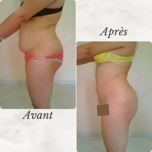 Dr Berrada Khalid - Chirurgien esthétique et plastique à Fès LIPOSUCCION dr berrada khalid photo avant apres2 chirurgie de la Silhouette