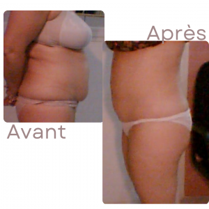 Dr Berrada Khalid - Chirurgien esthétique et plastique à Fès LIPOSUCCION dr berrada khalid photo avant apres3 1 chirurgie de la Silhouette