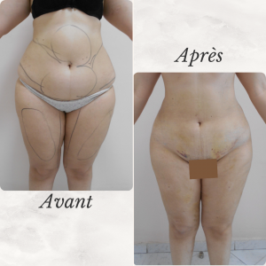 Dr Berrada Khalid - Chirurgien esthétique et plastique à Fès LIPOSUCCION dr berrada khalid photo avant apres5 chirurgie de la Silhouette