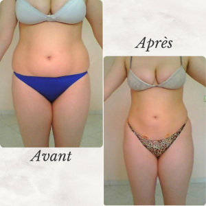 Dr Berrada Khalid - Chirurgien esthétique et plastique à Fès LIPOSUCCION dr berrada khalid photo avant apres7 chirurgie de la Silhouette