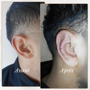 Chirurgie du visage 37 Dr Berrada Khalid - Chirurgien esthétique et plastique à Fès OTOPLASTIE dr berrada khalid photo avant apres13 Chirurgie du visage