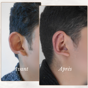 Accueil 26 Dr Berrada Khalid - Chirurgien esthétique et plastique à Fès OTOPLASTIE dr berrada khalid photo avant apres2 Accueil