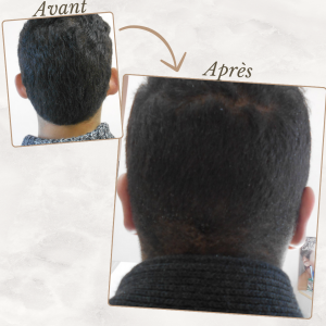 Chirurgie du visage 35 Dr Berrada Khalid - Chirurgien esthétique et plastique à Fès OTOPLASTIE dr berrada khalid photo avant apres3 Chirurgie du visage