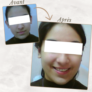 Chirurgie du visage 33 Dr Berrada Khalid - Chirurgien esthétique et plastique à Fès OTOPLASTIE dr berrada khalid photo avant apres5 Chirurgie du visage