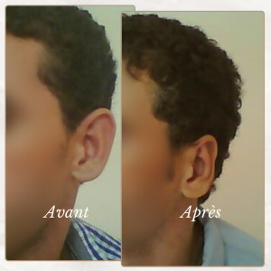 Chirurgie du visage 36 Dr Berrada Khalid - Chirurgien esthétique et plastique à Fès OTOPLASTIE dr berrada khalid photo avant apres8 Chirurgie du visage