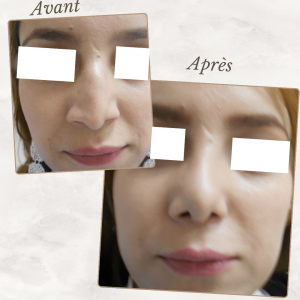 Chirurgie du visage 30 Dr Berrada Khalid - Chirurgien esthétique et plastique à Fès RHINOPLASTIE dr berrada khalid photo avant apres10 Chirurgie du visage