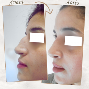 Chirurgie du visage 31 Dr Berrada Khalid - Chirurgien esthétique et plastique à Fès RHINOPLASTIE dr berrada khalid photo avant apres12 Chirurgie du visage