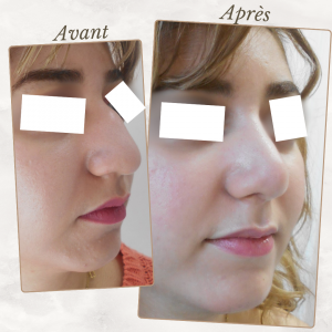 Chirurgie du visage 32 Dr Berrada Khalid - Chirurgien esthétique et plastique à Fès RHINOPLASTIE dr berrada khalid photo avant apres13 Chirurgie du visage