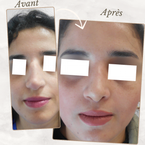 Chirurgie du visage 23 Dr Berrada Khalid - Chirurgien esthétique et plastique à Fès RHINOPLASTIE dr berrada khalid photo avant apres14 Chirurgie du visage