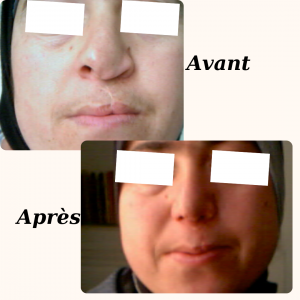 Chirurgie du visage 24 Dr Berrada Khalid - Chirurgien esthétique et plastique à Fès RHINOPLASTIE dr berrada khalid photo avant apres17 Chirurgie du visage