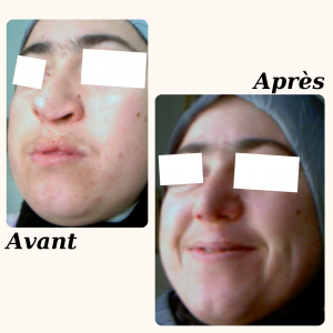 Chirurgie du visage 25 Dr Berrada Khalid - Chirurgien esthétique et plastique à Fès RHINOPLASTIE dr berrada khalid photo avant apres18 Chirurgie du visage