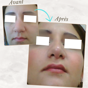 Chirurgie du visage 26 Dr Berrada Khalid - Chirurgien esthétique et plastique à Fès RHINOPLASTIE dr berrada khalid photo avant apres3 Chirurgie du visage