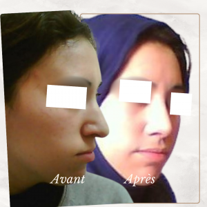 Chirurgie du visage 27 Dr Berrada Khalid - Chirurgien esthétique et plastique à Fès RHINOPLASTIE dr berrada khalid photo avant apres6 Chirurgie du visage