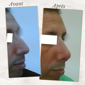 Chirurgie du visage 28 Dr Berrada Khalid - Chirurgien esthétique et plastique à Fès RHINOPLASTIE dr berrada khalid photo avant apres7 Chirurgie du visage