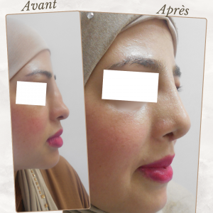 Chirurgie du visage 29 Dr Berrada Khalid - Chirurgien esthétique et plastique à Fès RHINOPLASTIE dr berrada khalid photo avant apres9 Chirurgie du visage