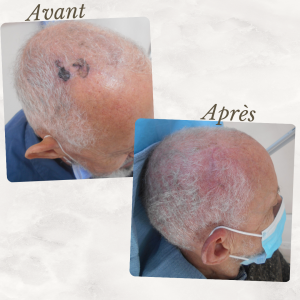 Dr Berrada Khalid - Chirurgien esthétique et plastique à Fès TUMEURS CUTANES dr berrada khalid photo avant apres 10 Chirurgie réparatrice