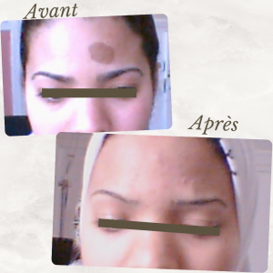 Dr Berrada Khalid - Chirurgien esthétique et plastique à Fès TUMEURS CUTANES dr berrada khalid photo avant apres 12 Chirurgie réparatrice