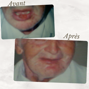 Dr Berrada Khalid - Chirurgien esthétique et plastique à Fès TUMEURS CUTANES dr berrada khalid photo avant apres 2 Chirurgie réparatrice