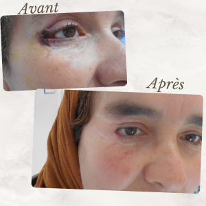 Dr Berrada Khalid - Chirurgien esthétique et plastique à Fès TUMEURS CUTANES dr berrada khalid photo avant apres 3 Chirurgie réparatrice