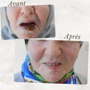 Accueil 27 Dr Berrada Khalid - Chirurgien esthétique et plastique à Fès TUMEURS CUTANES dr berrada khalid photo avant apres 4 Accueil