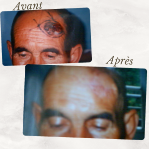 Dr Berrada Khalid - Chirurgien esthétique et plastique à Fès TUMEURS CUTANES dr berrada khalid photo avant apres 5 Chirurgie réparatrice