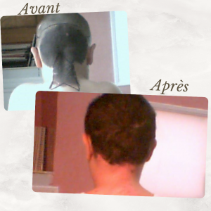 Dr Berrada Khalid - Chirurgien esthétique et plastique à Fès TUMEURS CUTANES dr berrada khalid photo avant apres 6 Chirurgie réparatrice