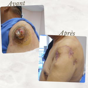 Dr Berrada Khalid - Chirurgien esthétique et plastique à Fès TUMEURS CUTANES dr berrada khalid photo avant apres 7 Chirurgie réparatrice