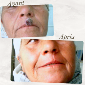 Dr Berrada Khalid - Chirurgien esthétique et plastique à Fès TUMEURS CUTANES dr berrada khalid photo avant apres 8 Chirurgie réparatrice
